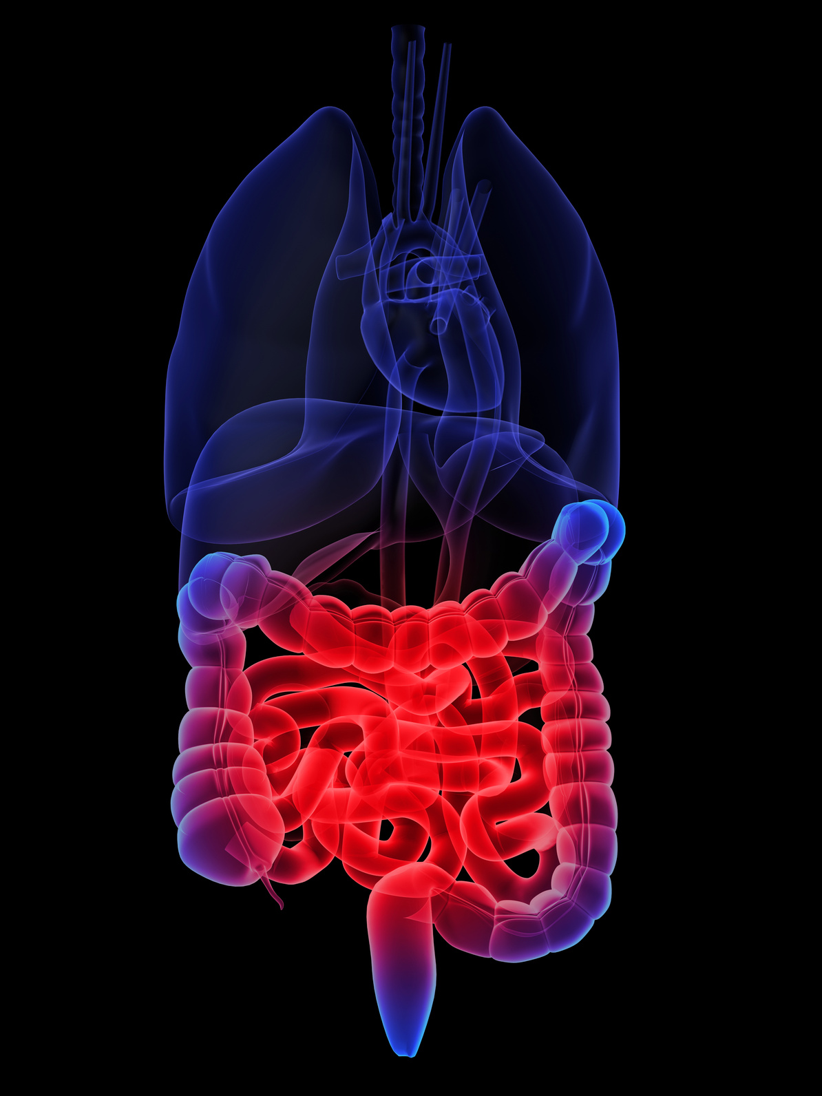 3D Darm-Modell mit Entzündungsherd, ©SciePro (Adobe Stock)